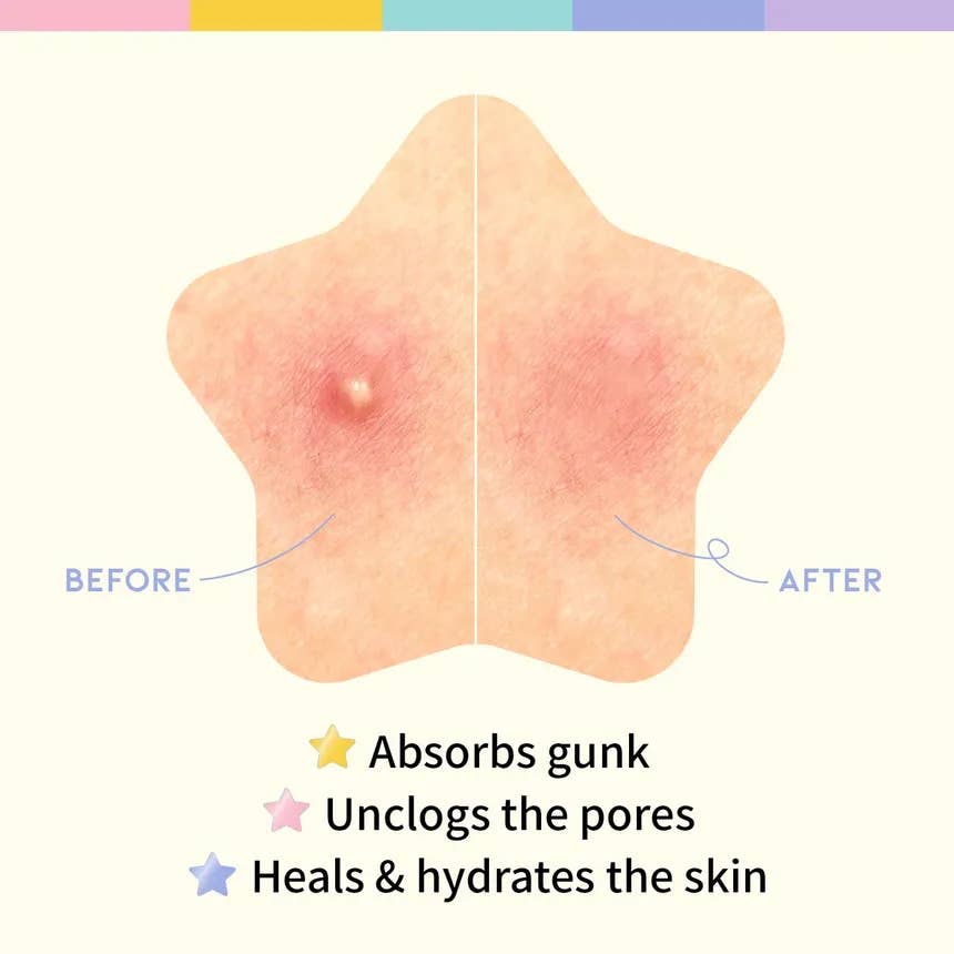 OOTD Star Spot Acne Hydrocolloid Patch 80 pieces - Image 5